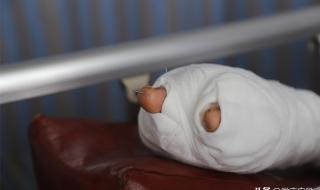 手指修复再造手术