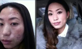 额头上长痘痘怎么调理 额头上长痘痘怎么调理